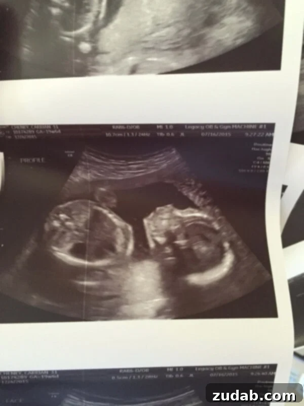 Hidden No More 3 Pregnant mom smiling, managing Hyperemesis Gravidarum symptoms